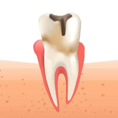 The stages of dental decay