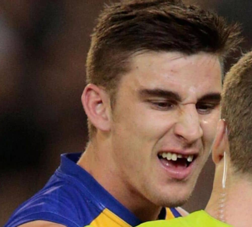 Knocked-out-tooth-AFL