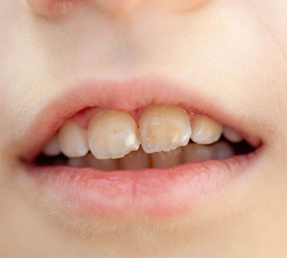 What causes white spots on teeth?
