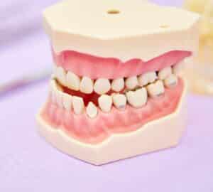 Malocclusion