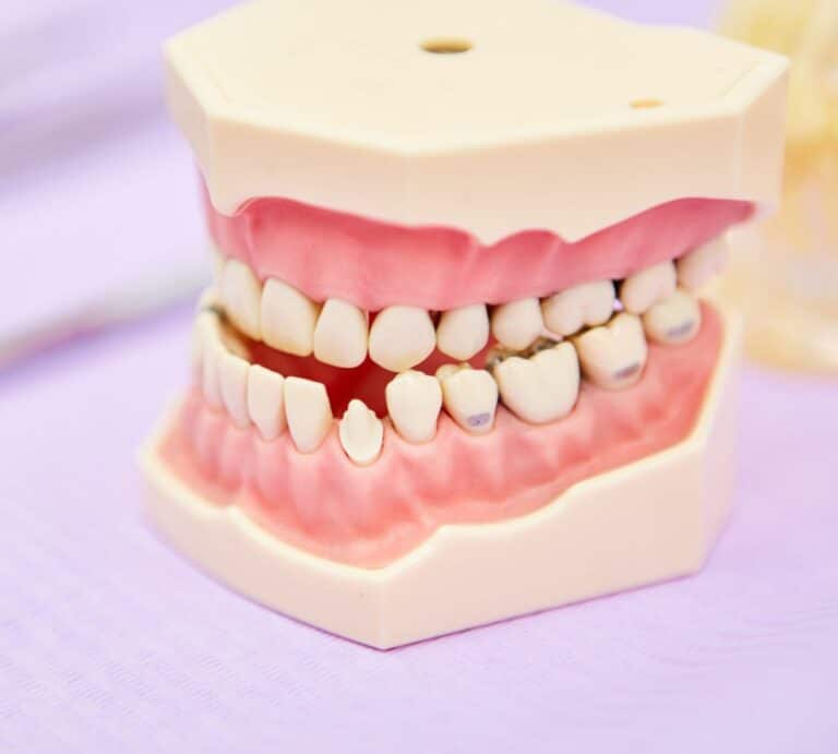 Malocclusion