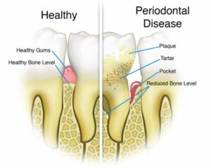 tooth decay develop