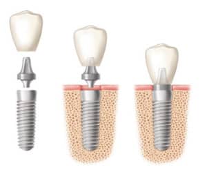 What are the different types of dental implants?