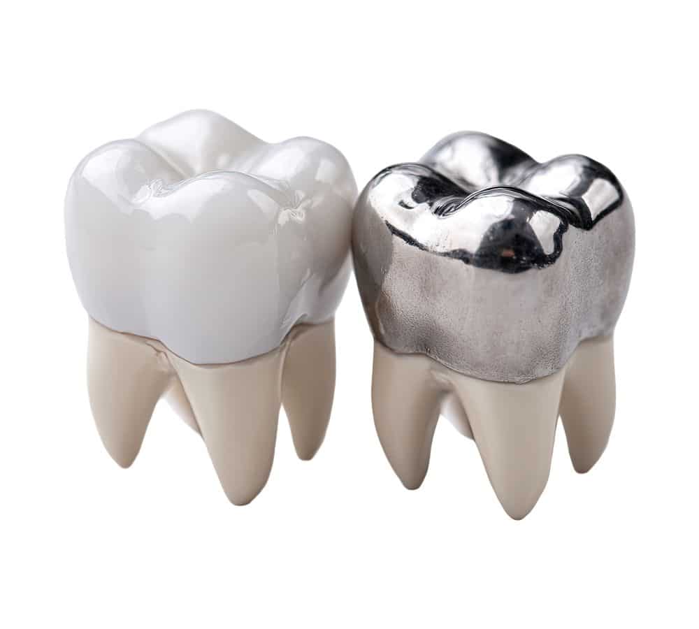 Dental fillings: porcelain, amalgam or composite resin?