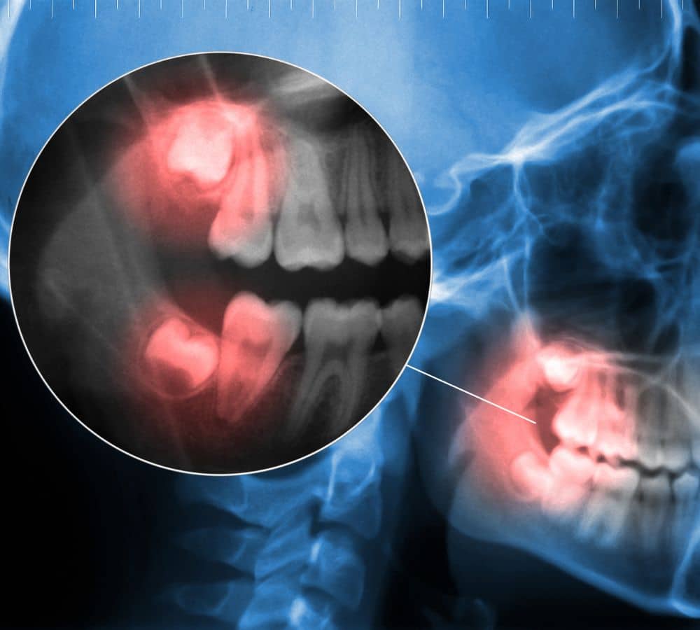 How long does it take to recover from wisdom teeth surgery?