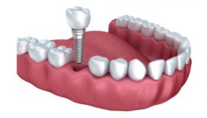 How much do dental implants cost?