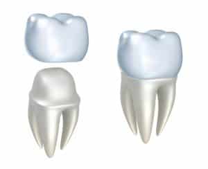 What is the difference between porcelain crowns and veneers?