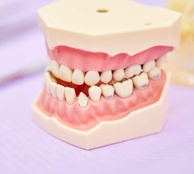 malocclusion