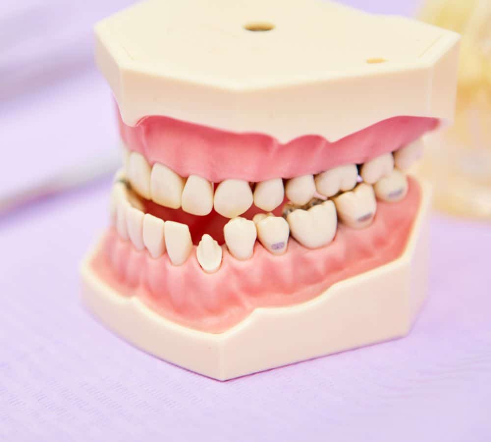 malocclusion