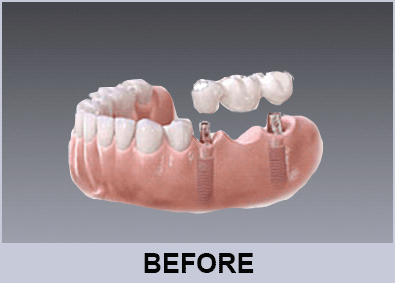 conventional implant retained ceramic bridge