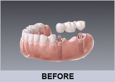Conventional Implants 2 conventional implant retained ceramic bridge