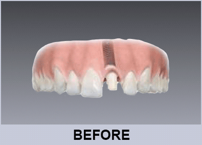 conventional implant retained ceramic crown