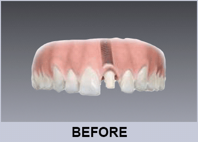Conventional Implants 1 conventional implant retained ceramic crown