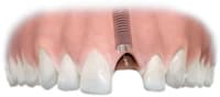 conventional dental implants