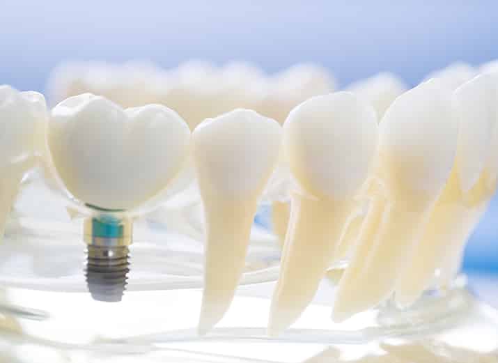 Dental Implants