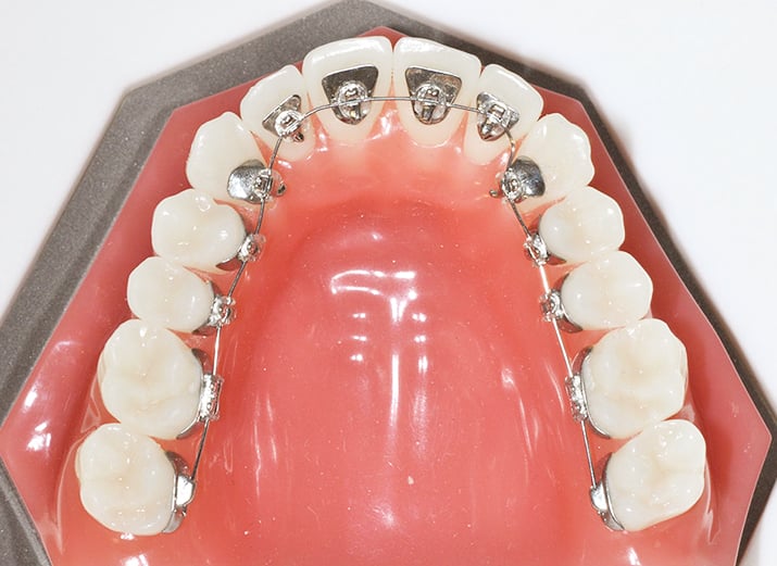 Internal Lingual Braces