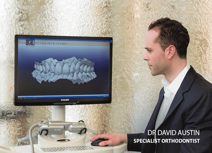 Internal lingual braces