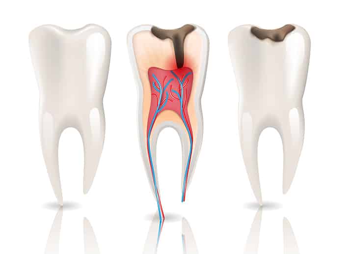 Root Canal