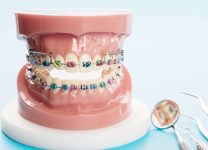 Traditional and Clear Braces