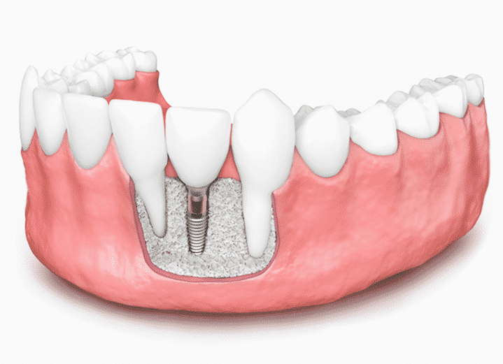 bone grafting for implants