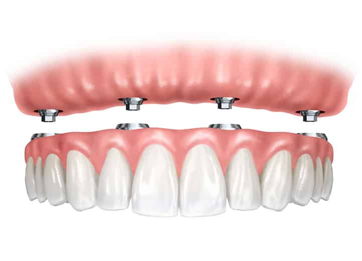 Teeth in 3 Days Full Arch Implants