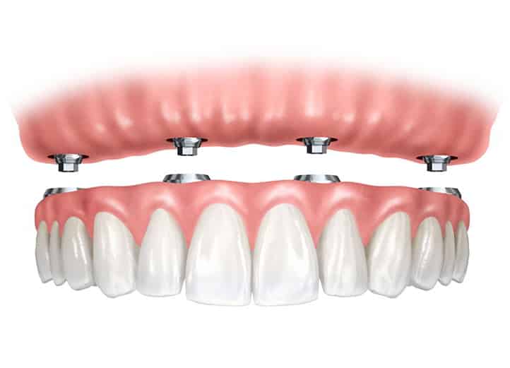 All-On-4 Dental Implants