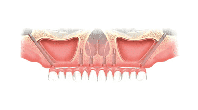 zygomatic implants