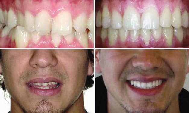 Invisalign Crossbite Before & After