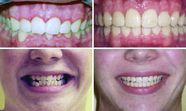 invisalign before overbite underbite afters braces smile solutions