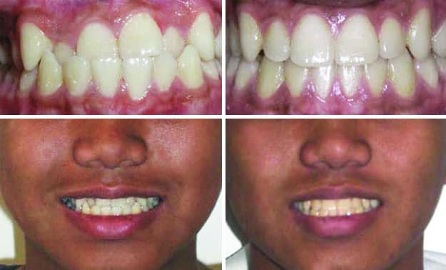 invisalign before underbite crossbite afters braces