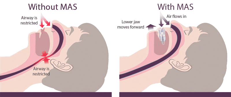 Mandibular Advancement Splint Ilustration