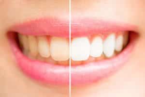 can improve whiteness teeth