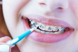 conventional braces questions answered