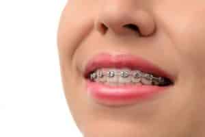 conventional braces vs lingual braces vs invisalign