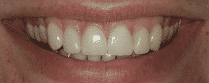 cosmetic dentistry options for improving the look for my smile