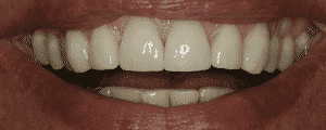 cosmetic dentistry options for improving the look for my smile