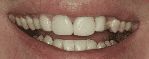 cosmetic dentistry options for improving the look for my smile
