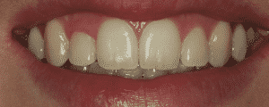 cosmetic dentistry options for improving the look for my smile