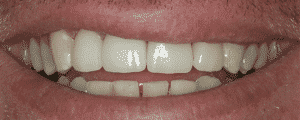 cosmetic dentistry options for improving the look for my smile