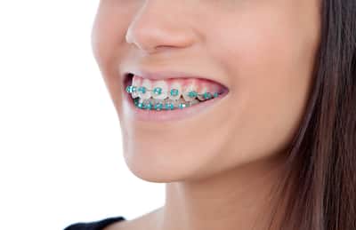 cost braces