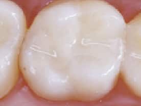 dental fillings composite