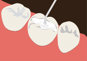 differences porcelain fillings composite fillings