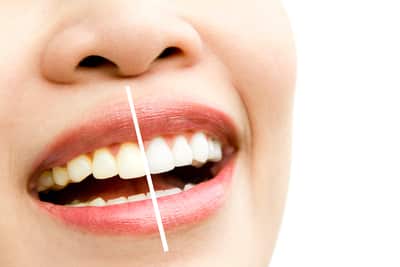 how long do teeth whitening effects last