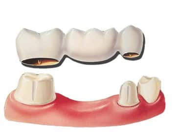 im looking get bridge replace tooth different types choose