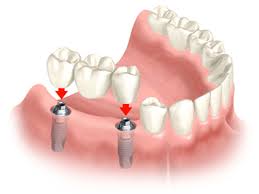 im looking get bridge replace tooth different types choose