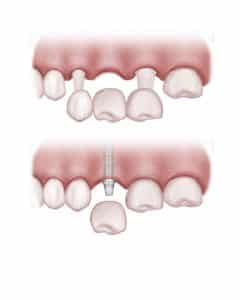 implant versus bridge for single tooth replacement