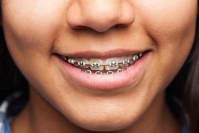 long child need wear braces