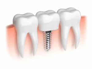 mini implants vs standard dental implants