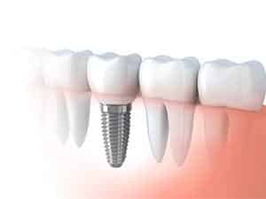 need know dental implants