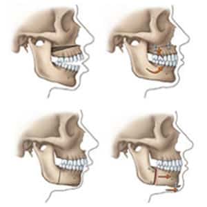 orthognathic surgery